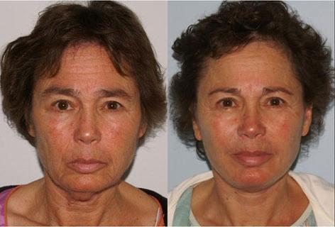 Facelift before and after photos in San Francisco, CA, Patient 14524
