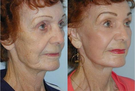 Facelift before and after photos in San Francisco, CA, Patient 14531