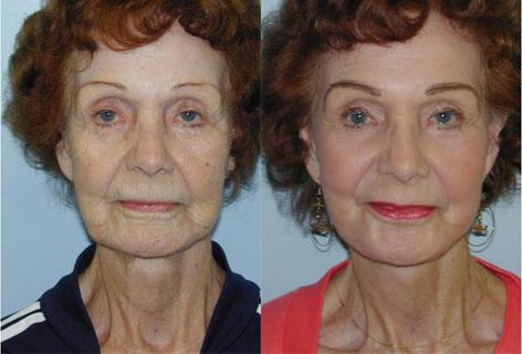 Facelift before and after photos in San Francisco, CA, Patient 14531