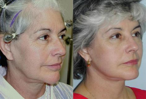 Facelift before and after photos in San Francisco, CA, Patient 14536