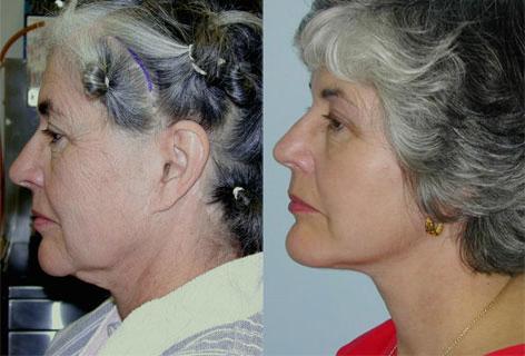 Facelift before and after photos in San Francisco, CA, Patient 14536