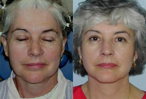 Facelift before and after photos in San Francisco, CA, Patient 14536