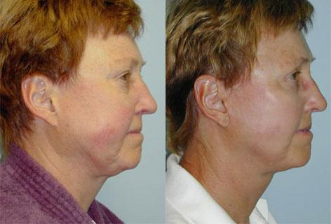 Facelift before and after photos in San Francisco, CA, Patient 14543