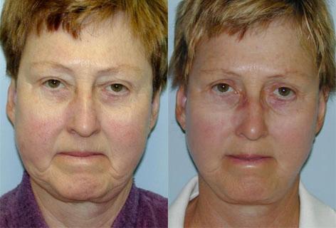 Facelift before and after photos in San Francisco, CA, Patient 14543