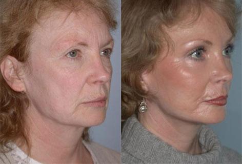 Facelift before and after photos in San Francisco, CA, Patient 14548