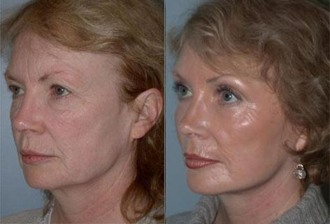 Facelift before and after photos in San Francisco, CA, Patient 14548