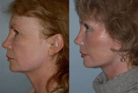 Facelift before and after photos in San Francisco, CA, Patient 14548