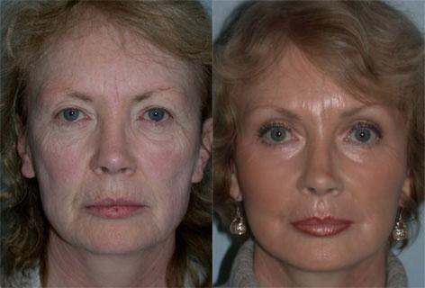 Facelift before and after photos in San Francisco, CA, Patient 14548