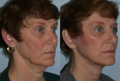 Facelift before and after photos in San Francisco, CA, Patient 14557