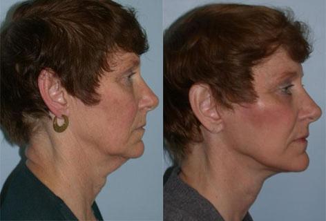 Facelift before and after photos in San Francisco, CA, Patient 14557