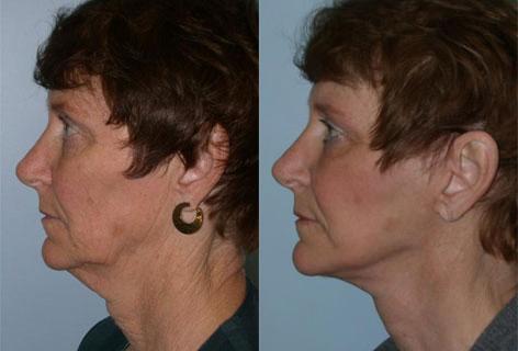 Facelift before and after photos in San Francisco, CA, Patient 14557