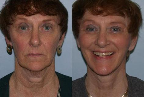 Facelift before and after photos in San Francisco, CA, Patient 14557