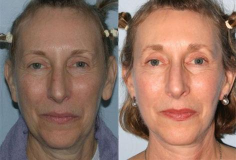 Facelift before and after photos in San Francisco, CA, Patient 14566