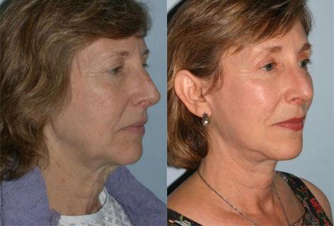 Facelift before and after photos in San Francisco, CA, Patient 14566