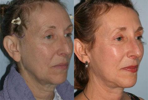 Facelift before and after photos in San Francisco, CA, Patient 14566