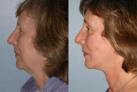 Facelift before and after photos in San Francisco, CA, Patient 14566