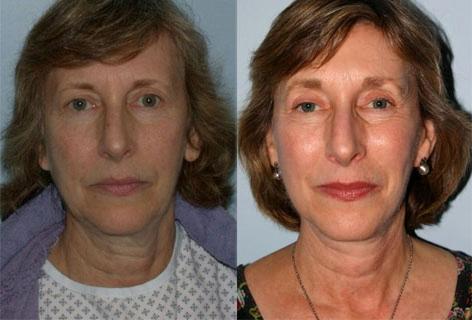 Facelift before and after photos in San Francisco, CA, Patient 14566