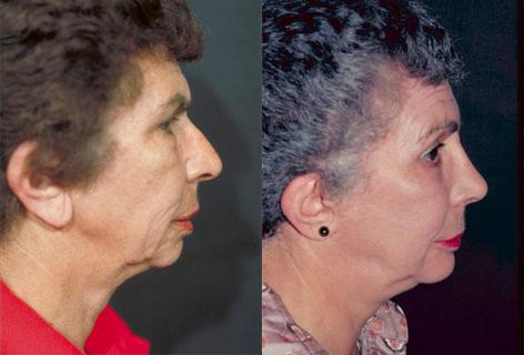 Facelift before and after photos in San Francisco, CA, Patient 14577