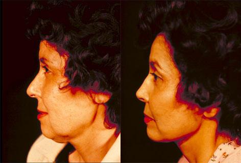 Facelift before and after photos in San Francisco, CA, Patient 14580