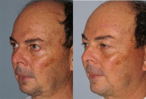 Facelift before and after photos in San Francisco, CA, Patient 14583
