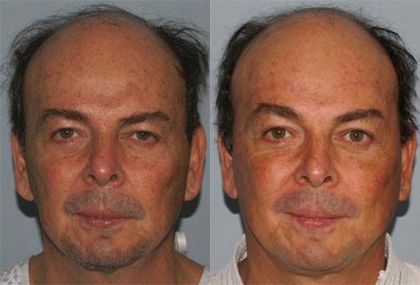Patient 14583, Facelift before and after photos Facelift before and after photos in San Francisco, CA, Patient 14583