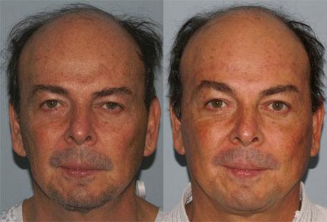 Facelift before and after photos in San Francisco, CA, Patient 14583