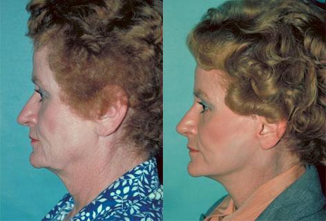 Facelift before and after photos in San Francisco, CA, Patient 14588