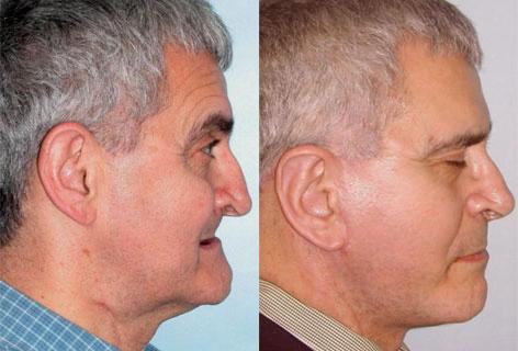 Facelift before and after photos in San Francisco, CA, Patient 14591