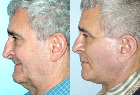 Facelift before and after photos in San Francisco, CA, Patient 14591