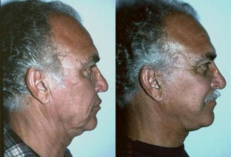 Facelift before and after photos in San Francisco, CA, Patient 14598