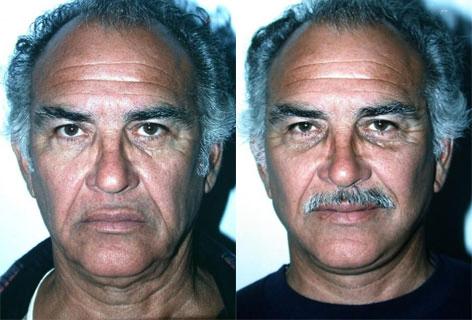 Facelift before and after photos in San Francisco, CA, Patient 14598