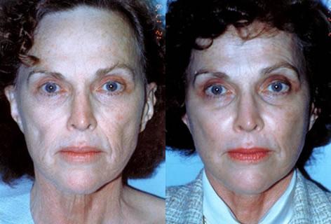 Facelift before and after photos in San Francisco, CA, Patient 14610