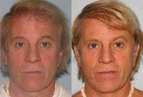 Facelift before and after photos in San Francisco, CA, Patient 14615