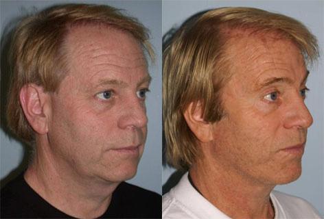 Facelift before and after photos in San Francisco, CA, Patient 14615