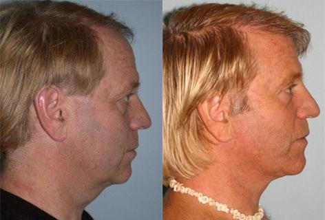 Facelift before and after photos in San Francisco, CA, Patient 14615