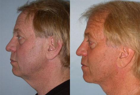 Facelift before and after photos in San Francisco, CA, Patient 14615