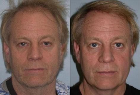 Facelift before and after photos in San Francisco, CA, Patient 14615