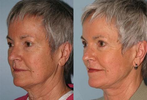 Facelift before and after photos in San Francisco, CA, Patient 14626
