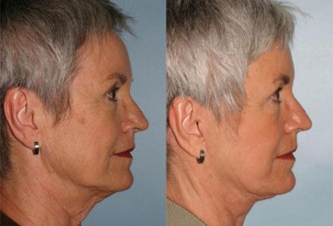 Facelift before and after photos in San Francisco, CA, Patient 14626