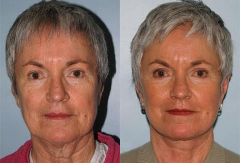 Facelift before and after photos in San Francisco, CA, Patient 14626