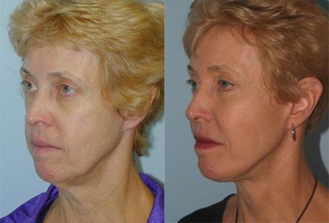 Facelift before and after photos in San Francisco, CA, Patient 14633