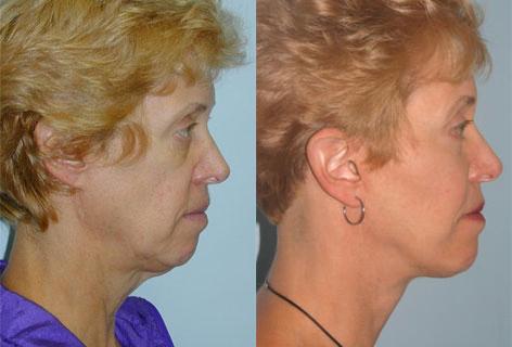 Facelift before and after photos in San Francisco, CA, Patient 14633