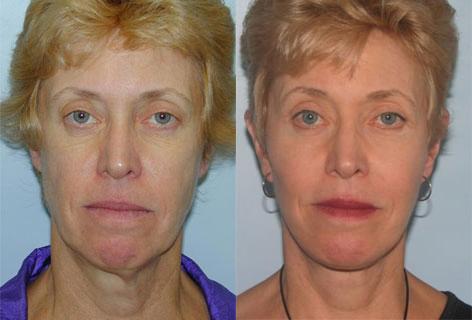 Facelift before and after photos in San Francisco, CA, Patient 14633