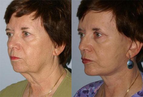 Facelift before and after photos in San Francisco, CA, Patient 14640