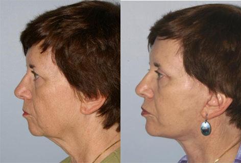 Facelift before and after photos in San Francisco, CA, Patient 14640