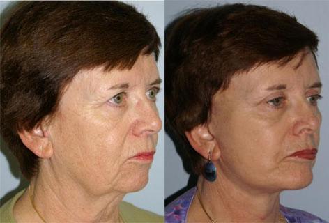 Facelift before and after photos in San Francisco, CA, Patient 14640