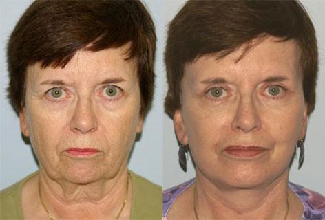 Facelift before and after photos in San Francisco, CA, Patient 14640