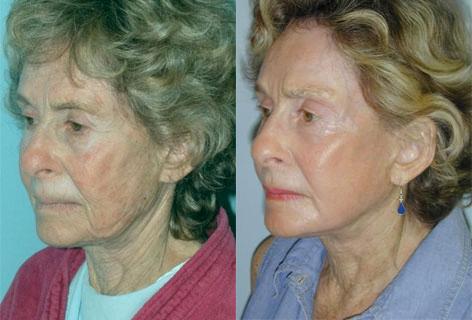 Facelift before and after photos in San Francisco, CA, Patient 14649