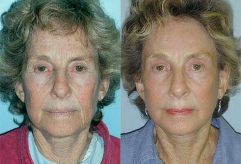 Facelift before and after photos in San Francisco, CA, Patient 14649