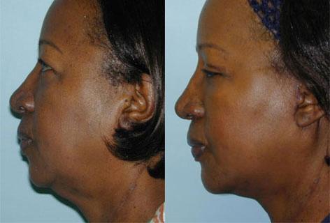 Facelift before and after photos in San Francisco, CA, Patient 14654